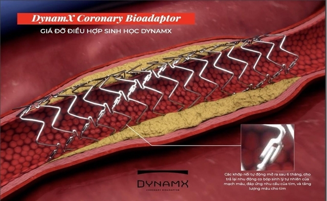 Stent tương thích sinh học thế hệ mới